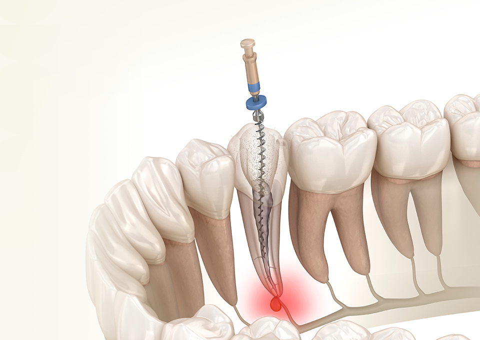 根管治療のイメージ画像