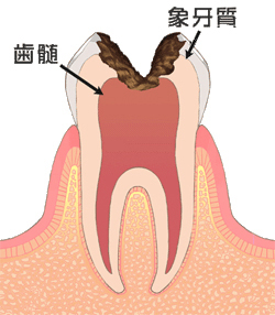 虫歯について